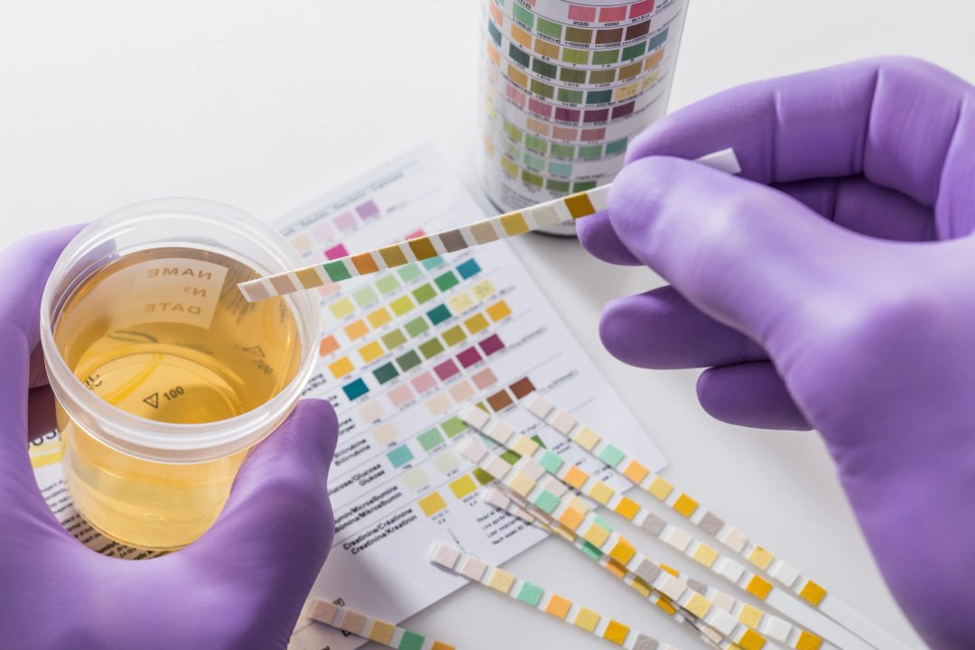 urinalysis